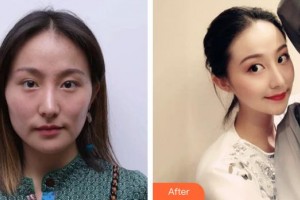 湘潭雅美醫(yī)療美容醫(yī)院劉志剛整形價格表附鼻部綜合案例展示