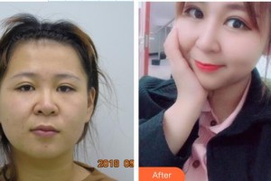 湘潭市中心醫(yī)院醫(yī)學(xué)整形美容科肖學(xué)敏住院醫(yī)師整形價格表附鼻部綜合案例展示