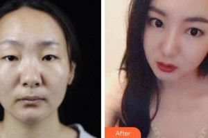 湘潭華雅整形美容醫(yī)院吳買平整形價格表附鼻部綜合案例展示