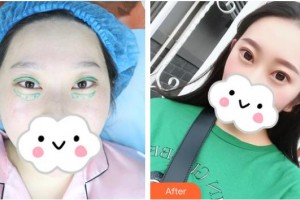 湘潭陽光門診部譚兵整形價格表附眼部綜合案例展示