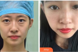 湘潭愛爾眼科醫(yī)院李仁華整形價格表附內(nèi)切祛眼袋案例展示