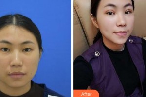 湘潭愛爾眼科醫(yī)院羅皓平整形價格表附定點雙眼皮案例展示