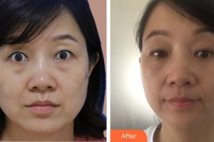 永州星雅醫(yī)療美容門診部譚超整形價(jià)格表附激光去黑眼圈案例展示