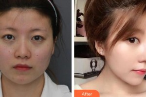 永州新唯美整形美容醫(yī)院劉曉紅整形價(jià)格表附鼻部綜合案例展示