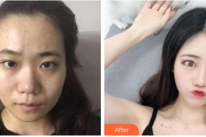 永州星雅醫(yī)療美容門診部張光輝整形價(jià)格表附鼻部綜合案例展示