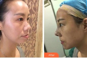 永州市皮膚病醫(yī)院醫(yī)療美容科艾玲玲整形價(jià)格表附	項(xiàng)目分類	鼻部整形案例展示