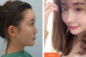 永州新唯美整形美容醫(yī)院李琴整形價(jià)格表附肋軟骨隆鼻案例展示