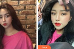 永州美辰整形美容醫(yī)院劉志高整形價(jià)格表附鼻部綜合案例展示