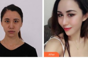 永州美辰整形美容醫(yī)院唐航整形價(jià)格表附鼻部綜合案例展示