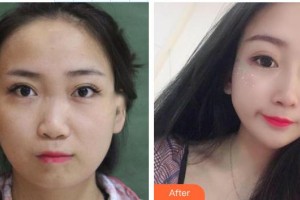 永州市皮膚病醫(yī)院醫(yī)療美容科蔣楊整形價(jià)格表附鼻部綜合案例展示