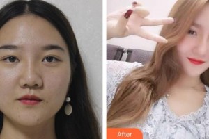 永州傾城醫(yī)療美容門診部嚴(yán)興萍整形價(jià)格表附假體隆鼻案例展示