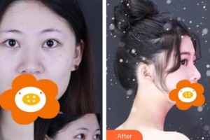 永州傾城醫(yī)療美容門診部楊維整形價(jià)格表附鼻部綜合案例展示