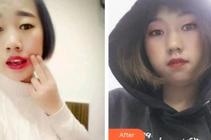 永州中南口腔醫(yī)院唐純玉整形價(jià)格表附根管調(diào)節(jié)案例展示