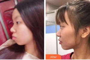 永州中南口腔醫(yī)院丁嵐整形價(jià)格表附金屬托槽矯正案例展示