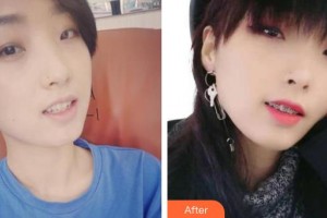 永州國(guó)斌口腔門診部劉阿寶整形價(jià)格表附金屬托槽矯正案例展示