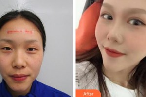 永州愛(ài)爾眼科醫(yī)院伍俊整形價(jià)格表附切開(kāi)雙眼皮案例展示