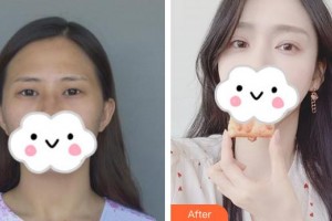 永州愛(ài)爾眼科醫(yī)院張艷整形價(jià)格表附眼部綜合案例展示