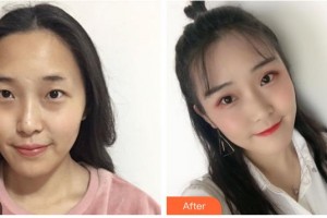 永州愛(ài)爾眼科醫(yī)院雷林國(guó)整形價(jià)格表附切開(kāi)雙眼皮案例展示