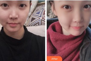 順德中西醫(yī)結(jié)合醫(yī)院整形激光美容醫(yī)療中心譚春明整形價格表附切開雙眼皮案例展示