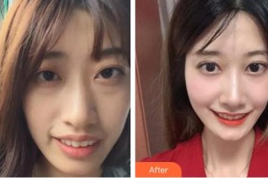 順德愛爾眼科醫(yī)院趙偉整形價格表附眼部綜合案例展示