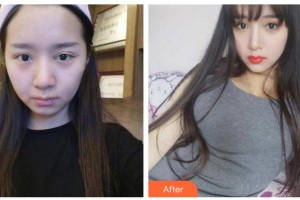 漢中華美醫(yī)療美容診所王巨曠整形價格表附埋線提升案例展示