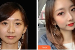 漢中卓美整形外科門診部李國棟整形價格表附熱瑪吉案例展示