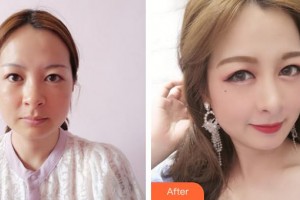 漢中南方醫(yī)療美容診所劉保林整形價格表附射頻緊膚案例展示