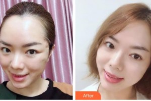 漢中韓美整形美容醫(yī)院李昭迎整形價格表附埋線提升案例展示