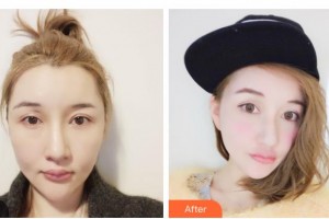 漢中華美奧萊醫(yī)學整形美容醫(yī)院郭增整形價格表附超聲提拉案例展示