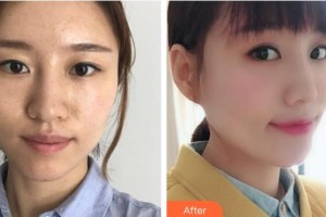 漢中天漢伊美醫(yī)療美容門診部劉思學整形價格表附埋線提升案例展示