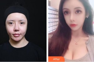 漢中南方醫(yī)療美容診所孫亞莉整形價格表附熱拉提案例展示