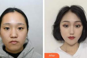 榆林博愛醫(yī)院整形美容中心蔡民銀整形價(jià)格表附眼部綜合案例展示