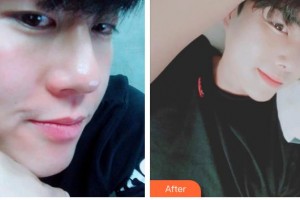 榆林愛爾眼科醫(yī)院李達(dá)整形價(jià)格表附眼部綜合案例展示