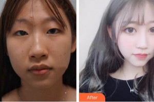 榆林市中醫(yī)醫(yī)院眼科醫(yī)院鄭樹鋒整形價格表附定點雙眼皮案例展示