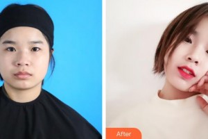 榆林愛爾眼科醫(yī)院蘇榆生整形價格表附眼部綜合案例展示