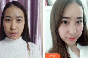 安康愛爾眼科醫(yī)院吳剛整形價(jià)格表附切開雙眼皮案例展示