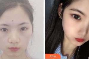 慶陽天成整形外科醫(yī)院王天成整形價格表附切開雙眼皮案例展示