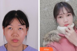 慶陽華美醫(yī)療美容診所張萬春整形價格表附眼部綜合案例展示