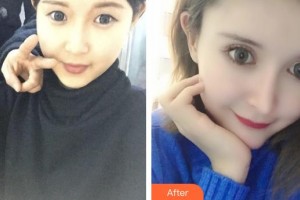 慶陽美立方醫(yī)學美容診所李梅整形價格表附眼部綜合案例展示