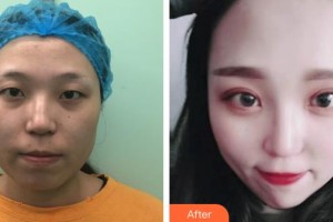 慶陽美立方醫(yī)學美容診所李智勇整形價格表附眼部綜合案例展示