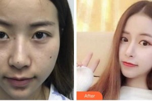 嘉峪關市紅十字長城醫(yī)院整形美容科靳長安整形價格表附埋線雙眼皮案例展示