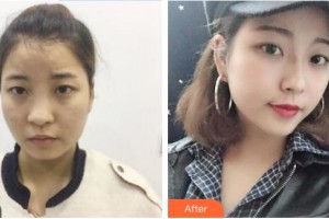 天水退休專家醫(yī)院醫(yī)療美容科魏智君整形價(jià)格表附鼻部綜合案例展示