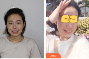 天水瑪莉亞（原女子）醫(yī)院醫(yī)學(xué)整形中心郭莉整形價(jià)格表附牙齒隱形矯正案例展示