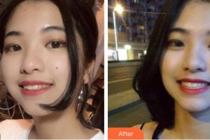 天水市中西醫(yī)結(jié)合醫(yī)院口腔頜面外科賈雙琴整形價(jià)格表附牙齒隱形矯正案例展示