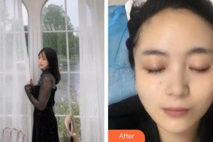 銀川慧頂醫(yī)學(xué)美容診所李鴻強(qiáng)整形價格表附黃金微針案例展示