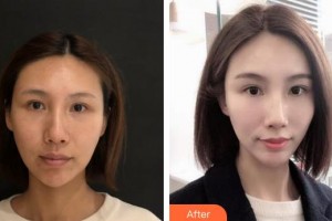 銀川靚鑫醫(yī)療美容診所張自強(qiáng)整形價格表附埋線提升案例展示