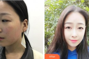 銀川百思美醫(yī)療美容診所陳永整形價格表附埋線提升案例展示