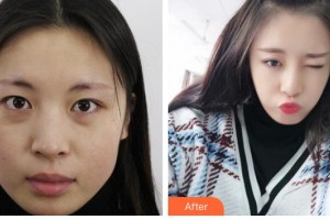 義烏愛爾眼科醫(yī)院李九可整形價格表附激光去眼袋展示