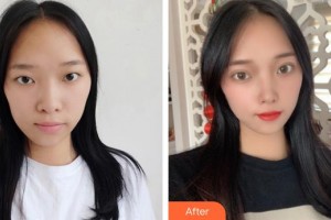 義烏愛爾眼科醫(yī)院陳曉華整形價格表附眼部綜合案例展示