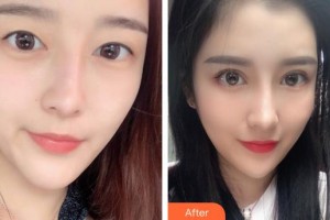 義烏視光眼科醫(yī)院楊衛(wèi)志整形價格表附眼部修復(fù)案例展示